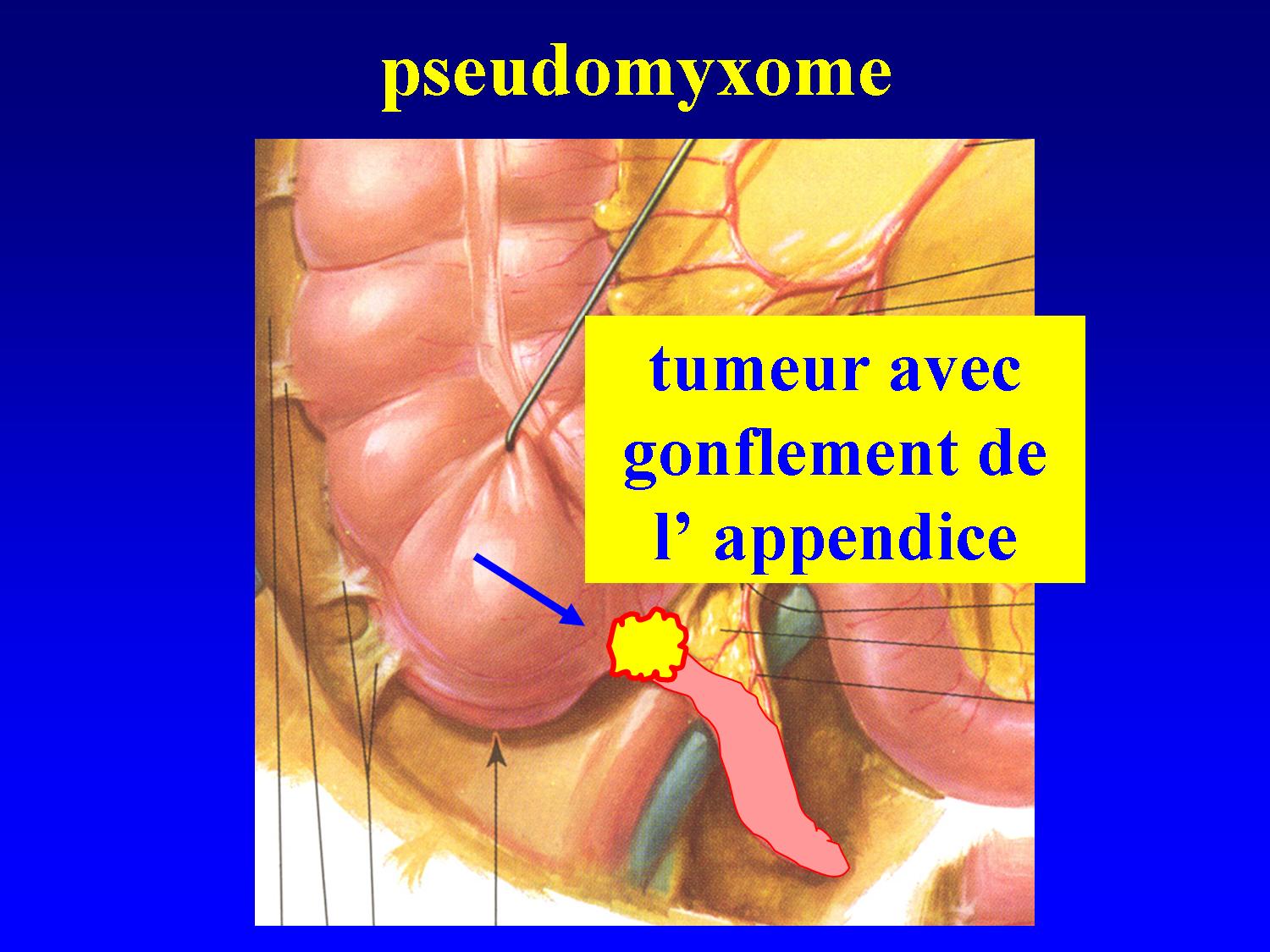 CHIP HIPEC OVHIPEC cancer du péritoine cancer péritonéal métastases péritonéales chimiothérapie